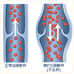 静脈弁について